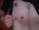 A New Third Nipple. Its Still There, 3 Months On